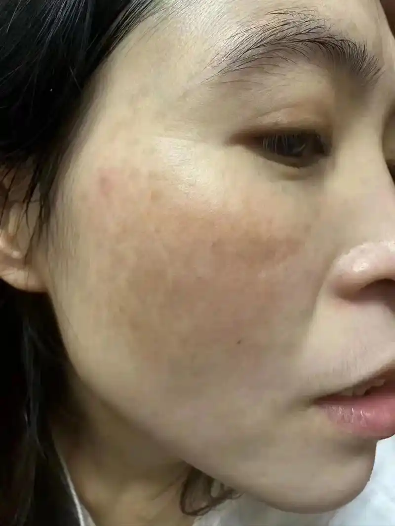 告别肌肤问题 #不做黄脸婆 美女黄褐斑一个月的效果图,无任 - 抖音