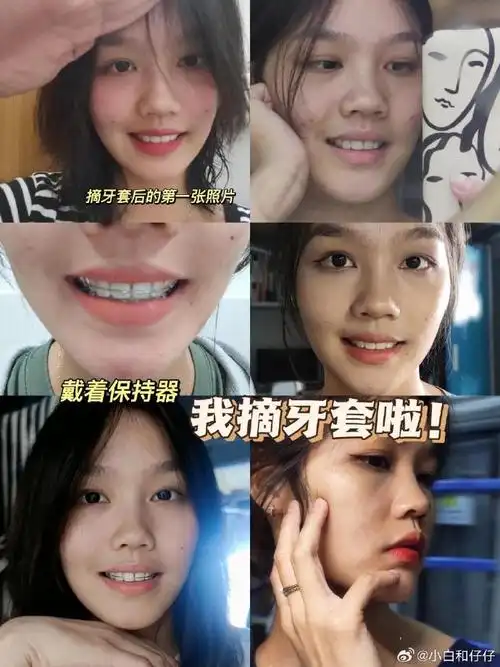 一个女生带两年多牙套的变化能有多大?