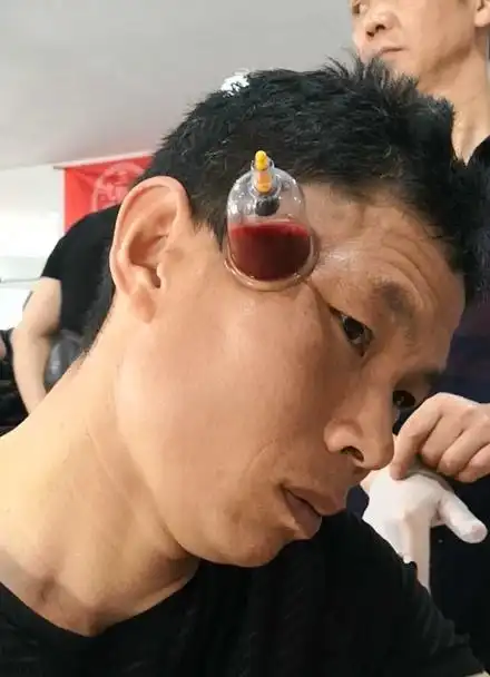 偏头痛失眠三叉神经痛拔罐放血疗法有奇效