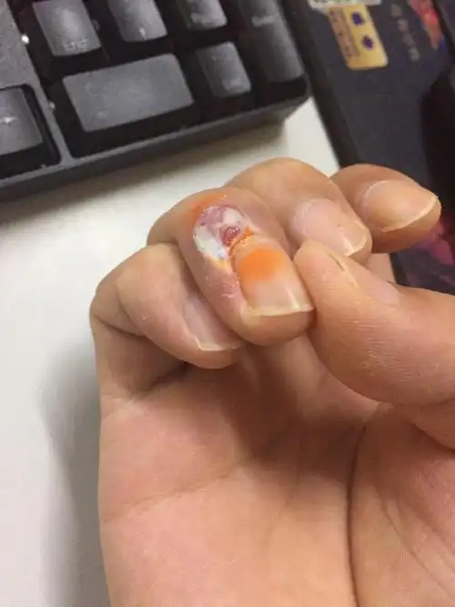 肉刺长什么样子图片 肉刺长什么样子图片初期