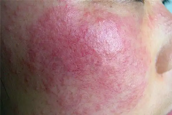 春天外出旅游易患过敏性皮炎 如何做好防护工作