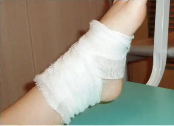 后她拿一些纱布自己包扎了一下,几天之后李阿姨在睡觉的时候感觉小腿