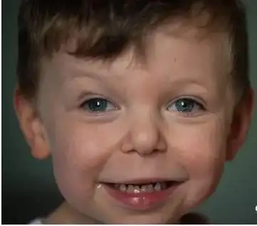 威廉姆斯综合征,是一种并不常见的遗传性疾病,大概两万人中才会有一人