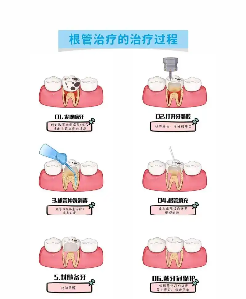 根管治疗全.#口腔科普 #牙齿 #一口好牙 #臻威口腔 #根 - 抖音