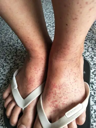 邹云辉医师临床医学综合门诊典型病例分享: 过敏性紫癜 地址:桃江大栗