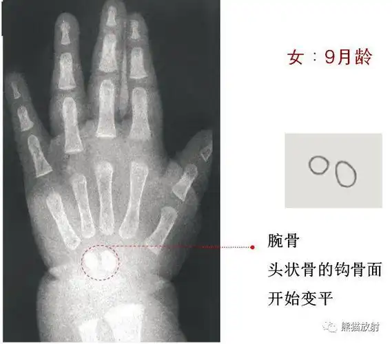 收藏丨骨龄图谱方便随时对照