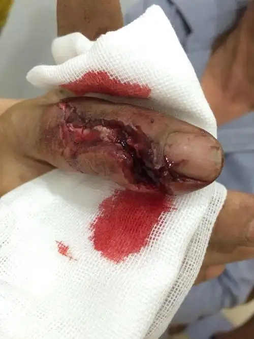 电锯割伤手指致手指开放性骨折