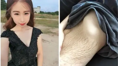 妊娠纹是怎么产生的?有预防或减轻的方法吗?