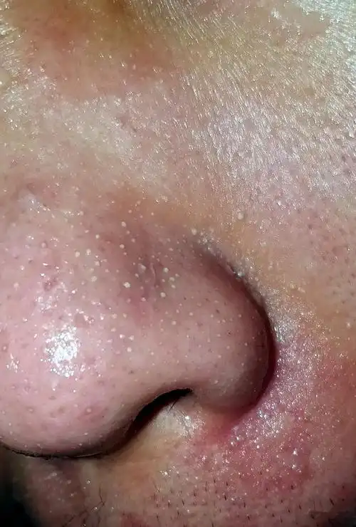 鼻子上能挤出好多"白条",而且没两天又冒出,这是为什么呢?