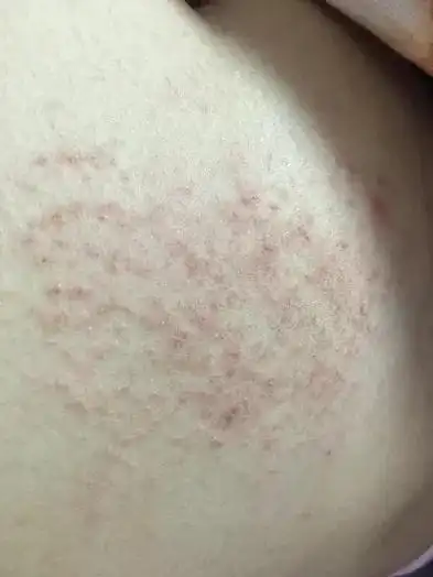 特应性皮炎和湿疹区别 - 搜狗图片搜索