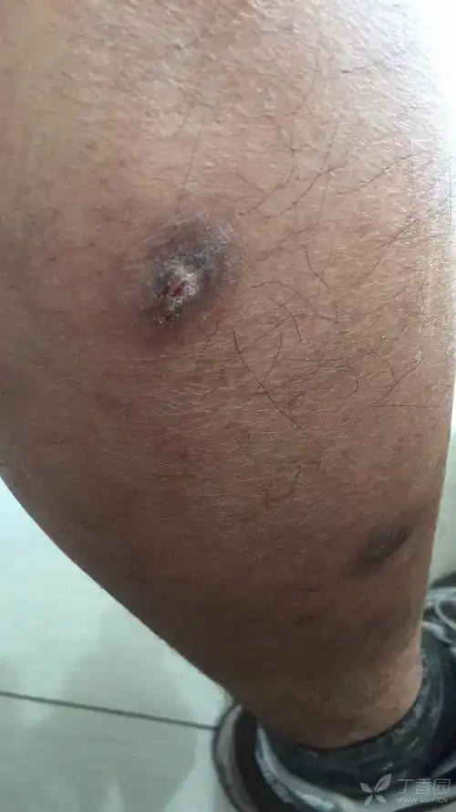 该病人右小腿多发皮肤黑色硬结节,无不适症状,望各位高手指点考虑何种