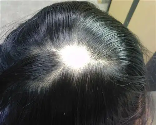 治疗脱发的地方