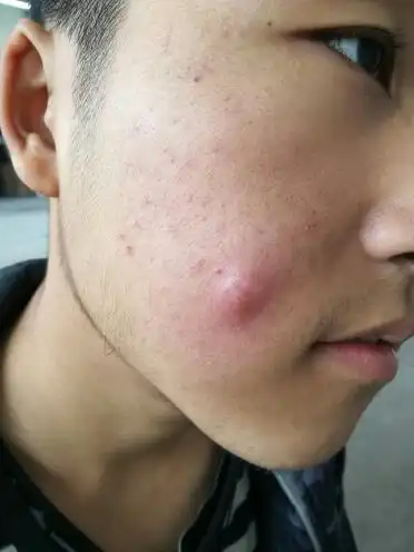 脸上长了一个大浓包,谁有过这种情况,怎么办.