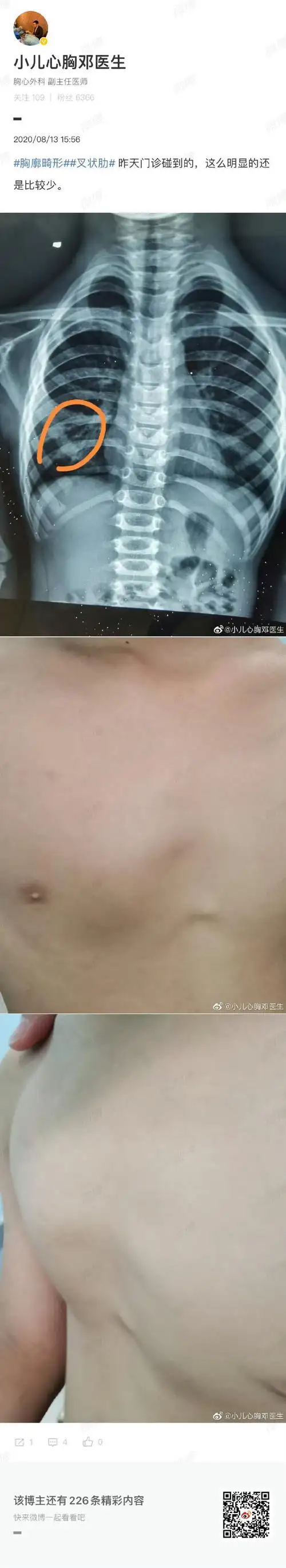 宝妈咨询##胸廓畸形##叉状肋