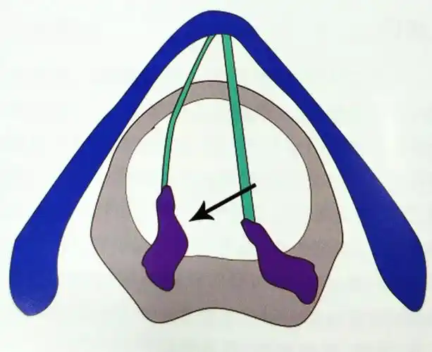 环杓关节脱位需准确把握最佳复位时间
