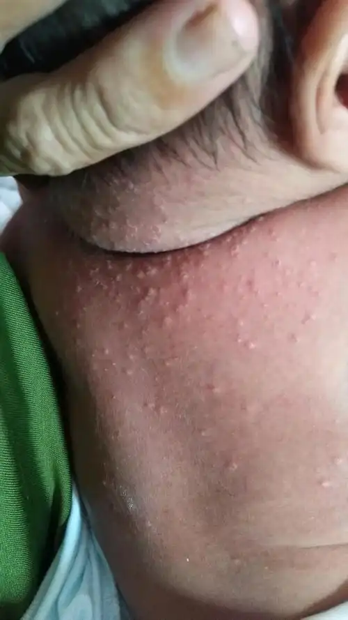 1 爱出汗的宝宝容易起热痱 宝宝排汗系统不完善,毛孔堵塞就长出热痱子