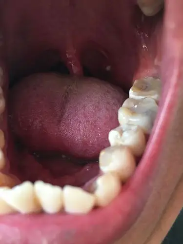 看看嗓子后面这是长了个白东西.严重吗