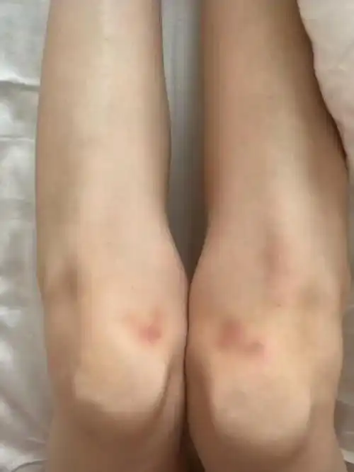 李小璐晒库存照双腿膝盖受伤暴瘦仅80斤甜馨素颜超像贾乃亮