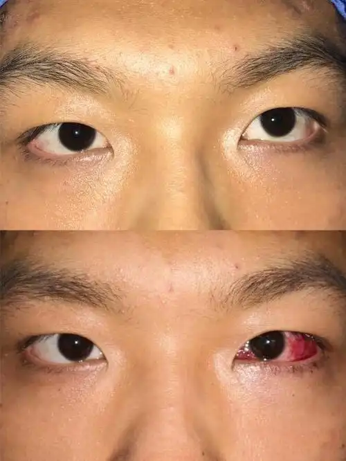 斜视的危害 - 好大夫在线