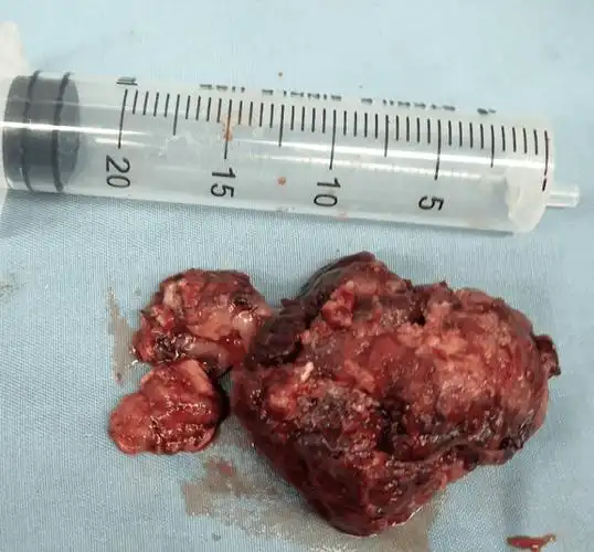 爱见新生右侧枕叶上皮样胶质母细胞瘤idh野生型患者早期使用stupp标准