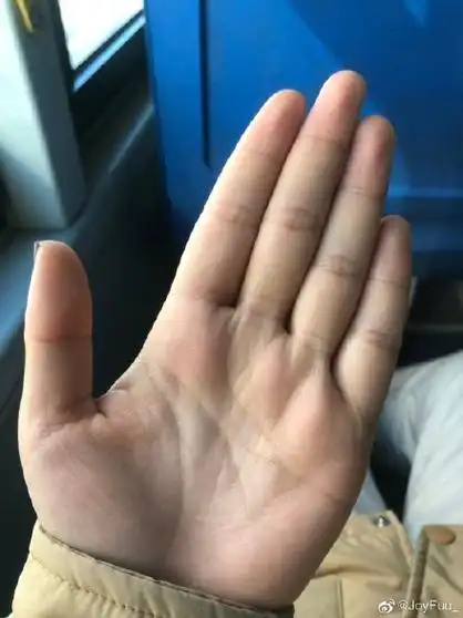 金星丘有些凹陷青筋,肠胃上有些小毛病,平时要多注意饮食问题