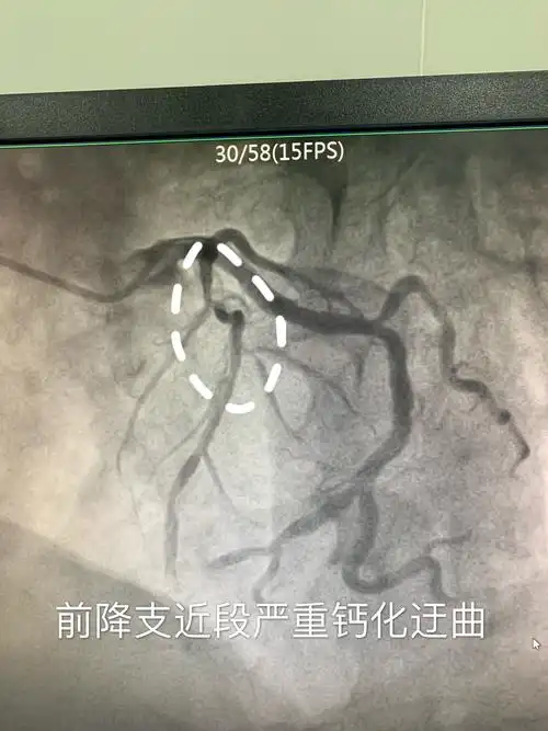 完善各项术前准备造影结束,冠脉造影显示前降支近段重度狭窄伴严重