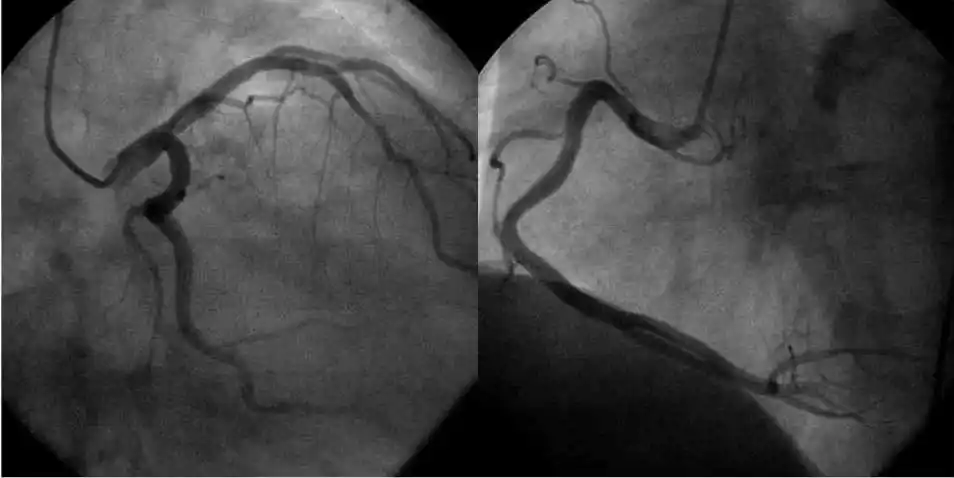 冠脉造影术在局部麻醉下进行,而血管及心脏内均无感觉神经,患者只在