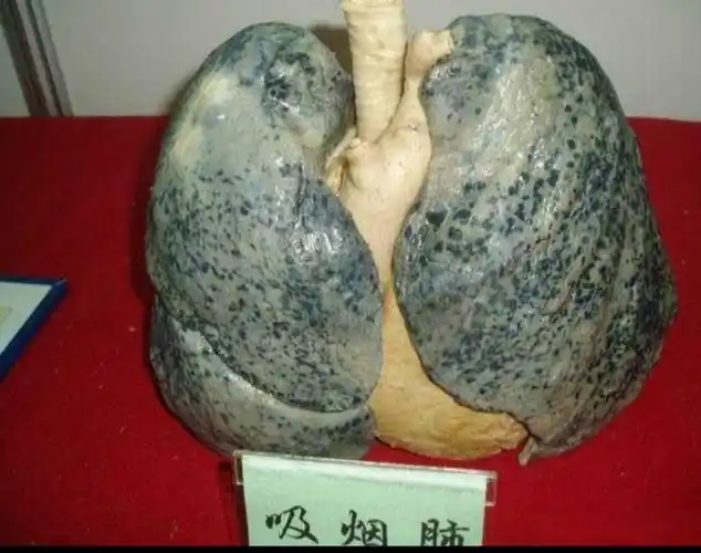 这是一个吸烟的肺