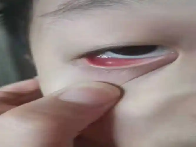 被大多数人误解的内睑腺炎再晚一步治疗可能要手术