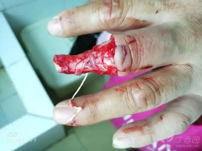 手指外伤,求指导