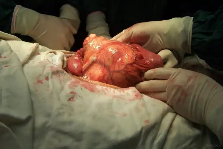 一罕见病例下腹部包块报告 讨论