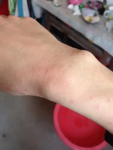 走路一热身上就出很多红点,不痒,一段时间后凉了红点就退了,请问这是