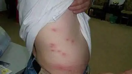 被虱子咬的图片(被虱子咬的图片咬了会怎么样)-玛卡通