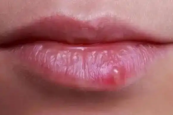 嘴唇上长疱疹图片