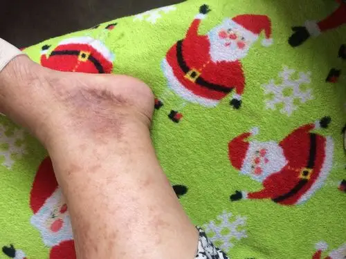 褐色的东西并且有蔓延趋势.请问这是怎么