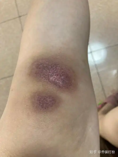 记录下电瓶车擦伤恢复全过程