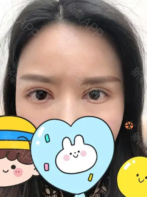 做了提肌效果真的太不一样了,现在眼睛轻松睁也是很大,很有神.