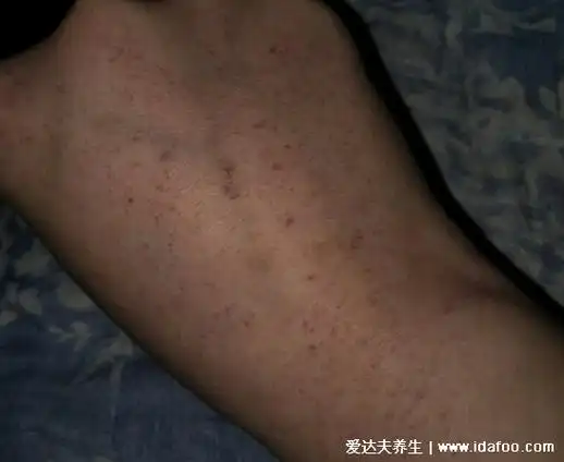 白血病早期出血点图片,多为紫红色针尖样小红点7大典型症状