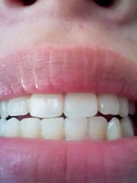 我这样的牙齿算是整齐的吗,刚整完牙觉得没有什么效果!