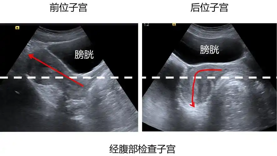 子宫前位与后位是什么意思?后位子宫有什么影响吗?_子宫后倾_介绍_检