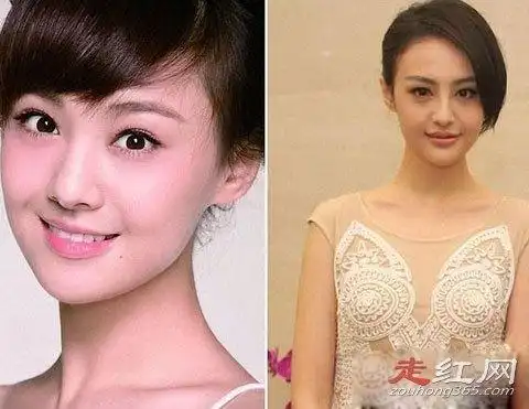 郑爽整容了吗取出假体前后对比照片