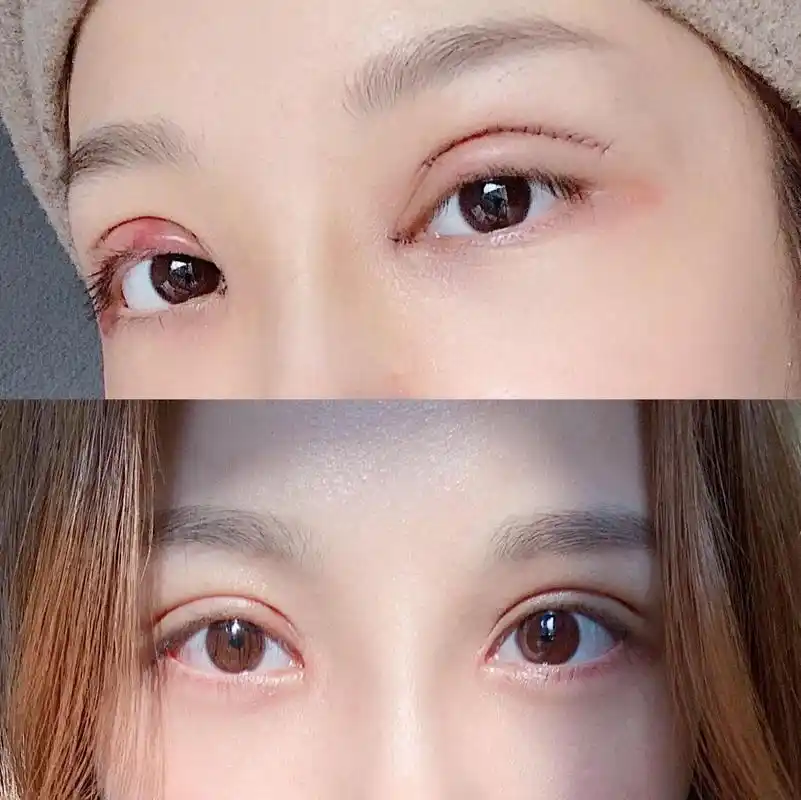 最自然好看的双眼皮长什么样