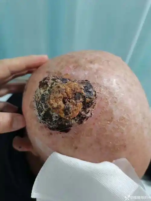 头皮恶性肿瘤切除及修复