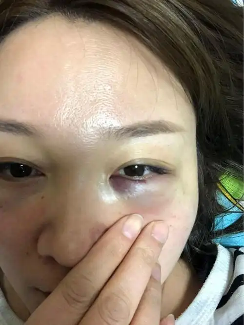 在当地整形医院玻尿酸填的泪沟