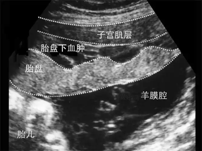 症状图片胎盘早剥血肿超声图片胎盘早剥诊断图胎盘早剥诊断图片胎盘早
