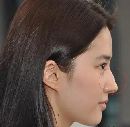 鼻子的驼峰虽然让她平添英气,但是对于想整容的女生来说,鼻部线条不够