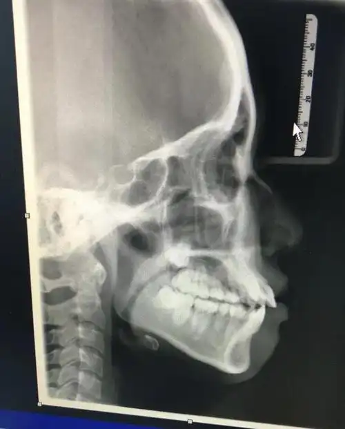 牙片八个月的侧脸差距