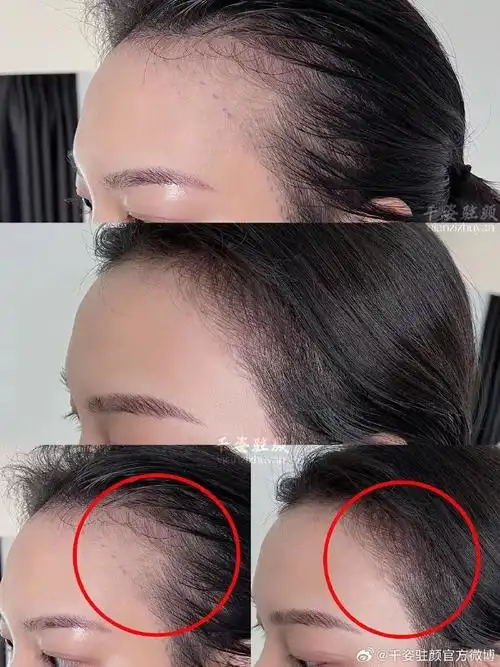 千姿驻颜|发际线前后对比