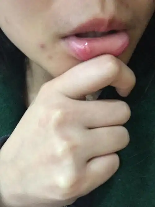 嘴唇外面长了个泡,三天了,痛死了,喝了凉茶也不见效,怎么办