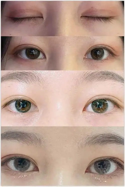 重庆自然双眼皮哪个医师做的好啊王量胡金香党宁邹大龙曹阳